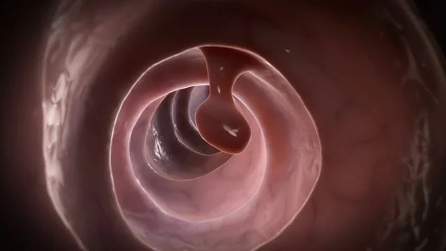 Thumbnail for video about what are colon polyps?