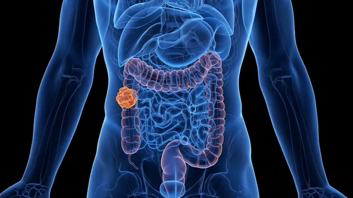 Thumbnail for video about what is colon cancer? rectal cancer?