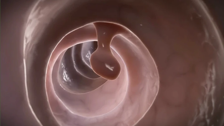 Thumbnail for video about what are colon polyps?