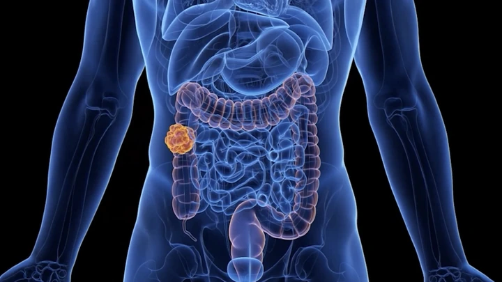 Thumbnail for video about what is colon cancer? rectal cancer?